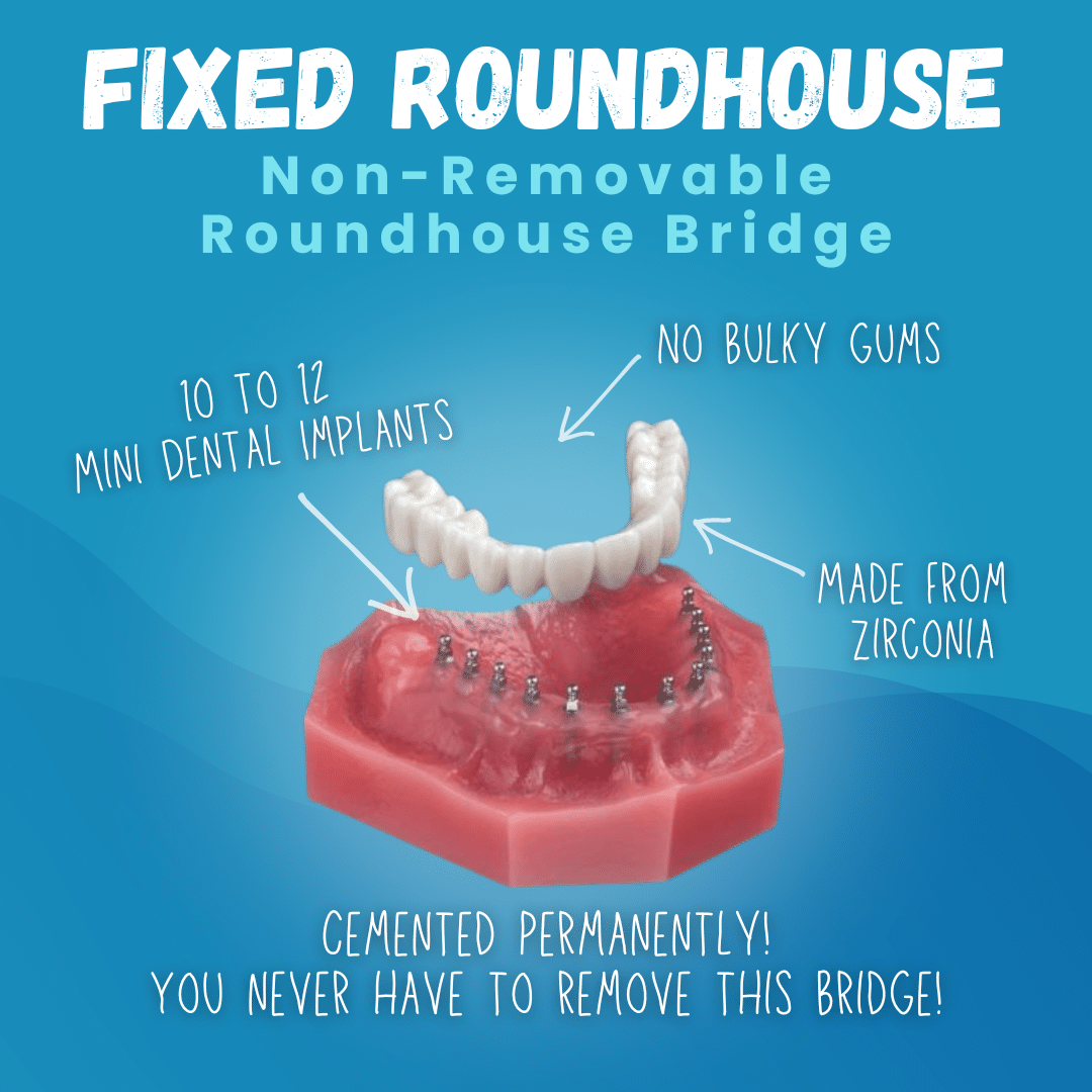 Fixed Roundhoue - Non-Removable Roundhoue Bridge